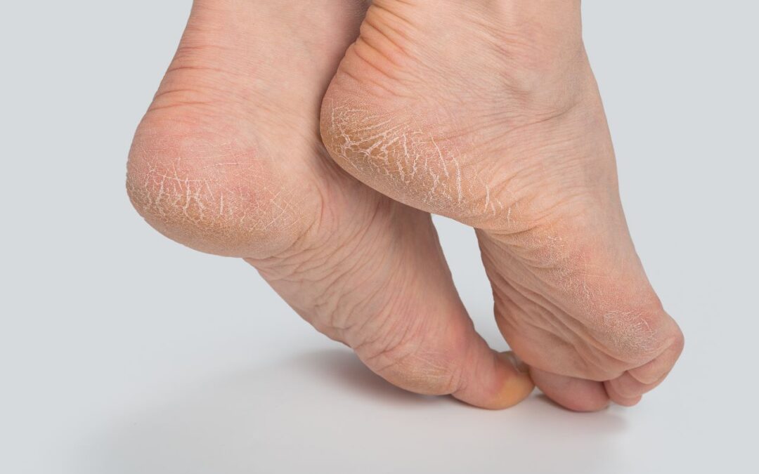 O que causa rachadura nos pés e como tratar