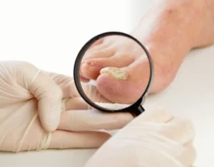 O que é Tratamento micose e onde fazer? Uma infecção fúngica comum que afeta a pele, unhas e mucosas, causando desconforto!
