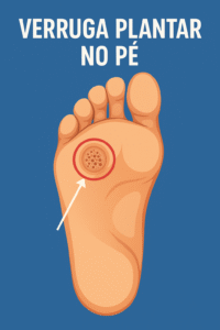 Verruga Plantar no pé - o que é, causas e tratamentos! Uma lesão cutânea causada pela infecção do papilomavírus humano (HPV)
