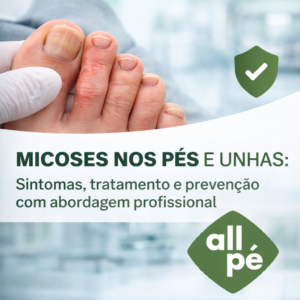 Micoses nos Pés e Unhas Sintomas, tratamento e prevenção com abordagem profissional - All Pé